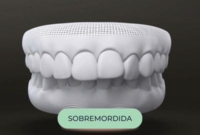 mordida - oralfy catanduva - dentista (1)